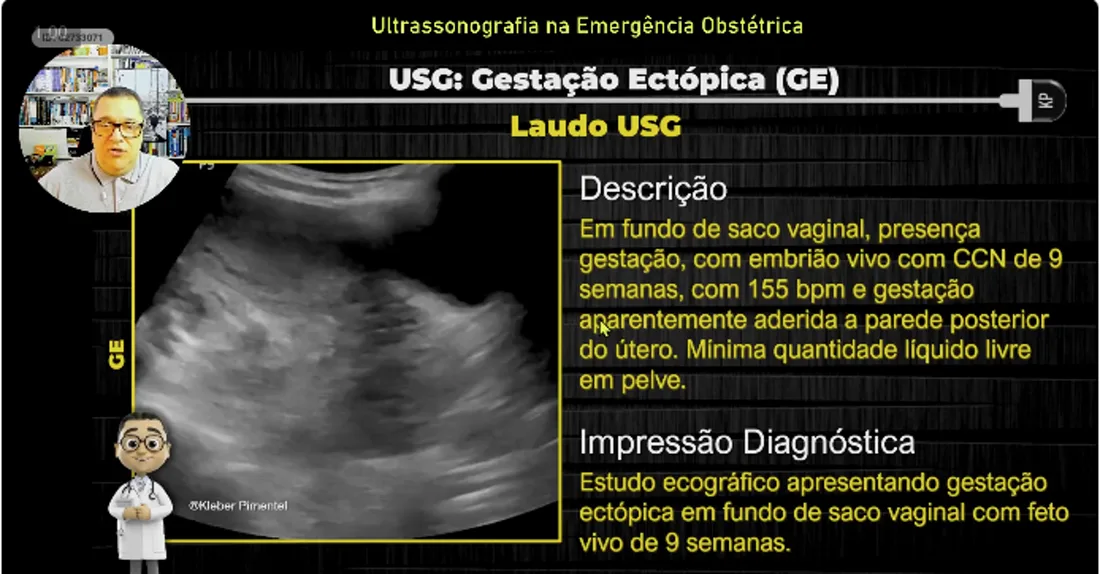 Slide da aula 04: Gravidez Ectópica