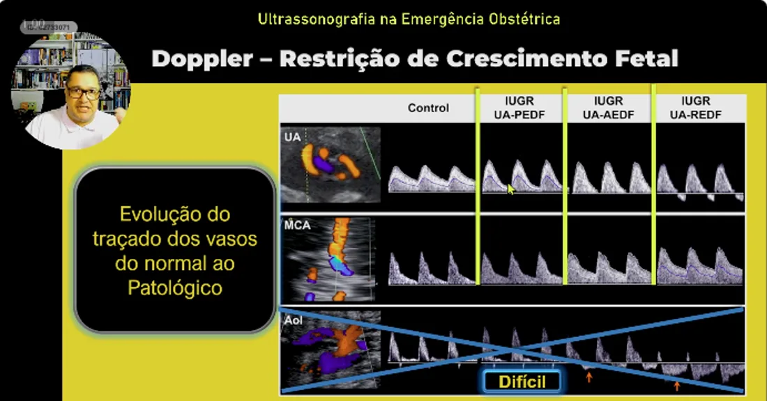 Slide da aula 10: Doppler na Emergência · Interpretação
