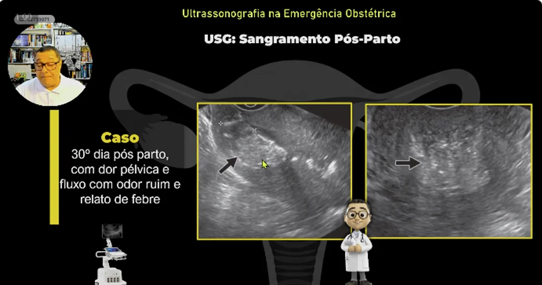 Slide da aula 11: Sangramento Pós-Parto