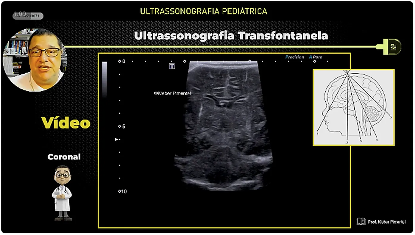 Slide da aula 2 sobre tecnica do exame transfontanelar