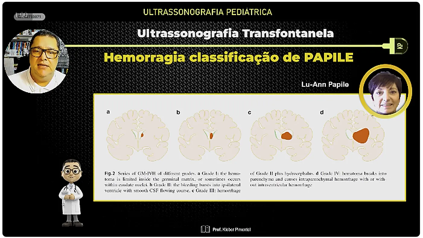 Slide da aula 3 sobre a classificacao de Papile das hemorragias