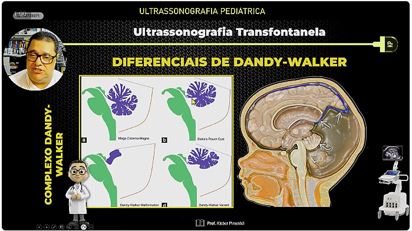 Slide da aula 4 sobre os diferenciais do complexo Dandy-Walker