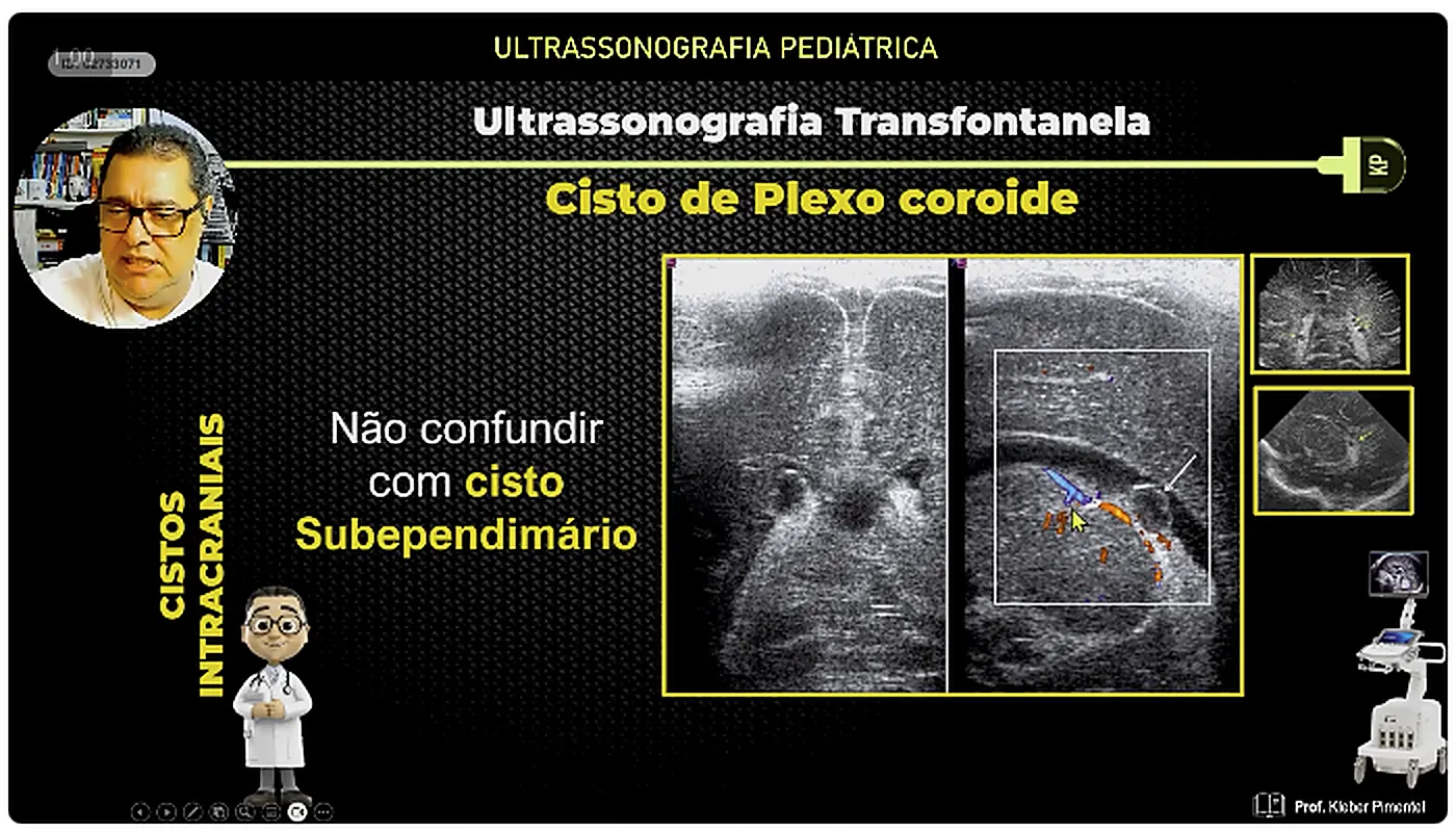 Slide da aula 5 sobre cisto de plexo coroide e cisto subependimario