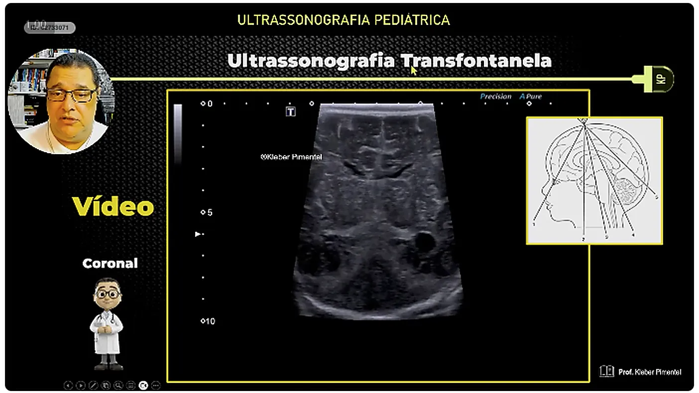 Slide da aula mostrando a varredura coronal sendo feita no bebe com transdutor linear