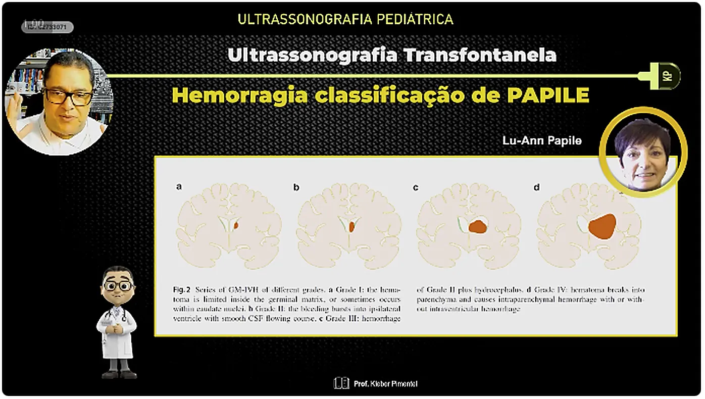 Slide da aula com a classificacao de Papile, mostrando os quatro graus de hemorragia periventricular