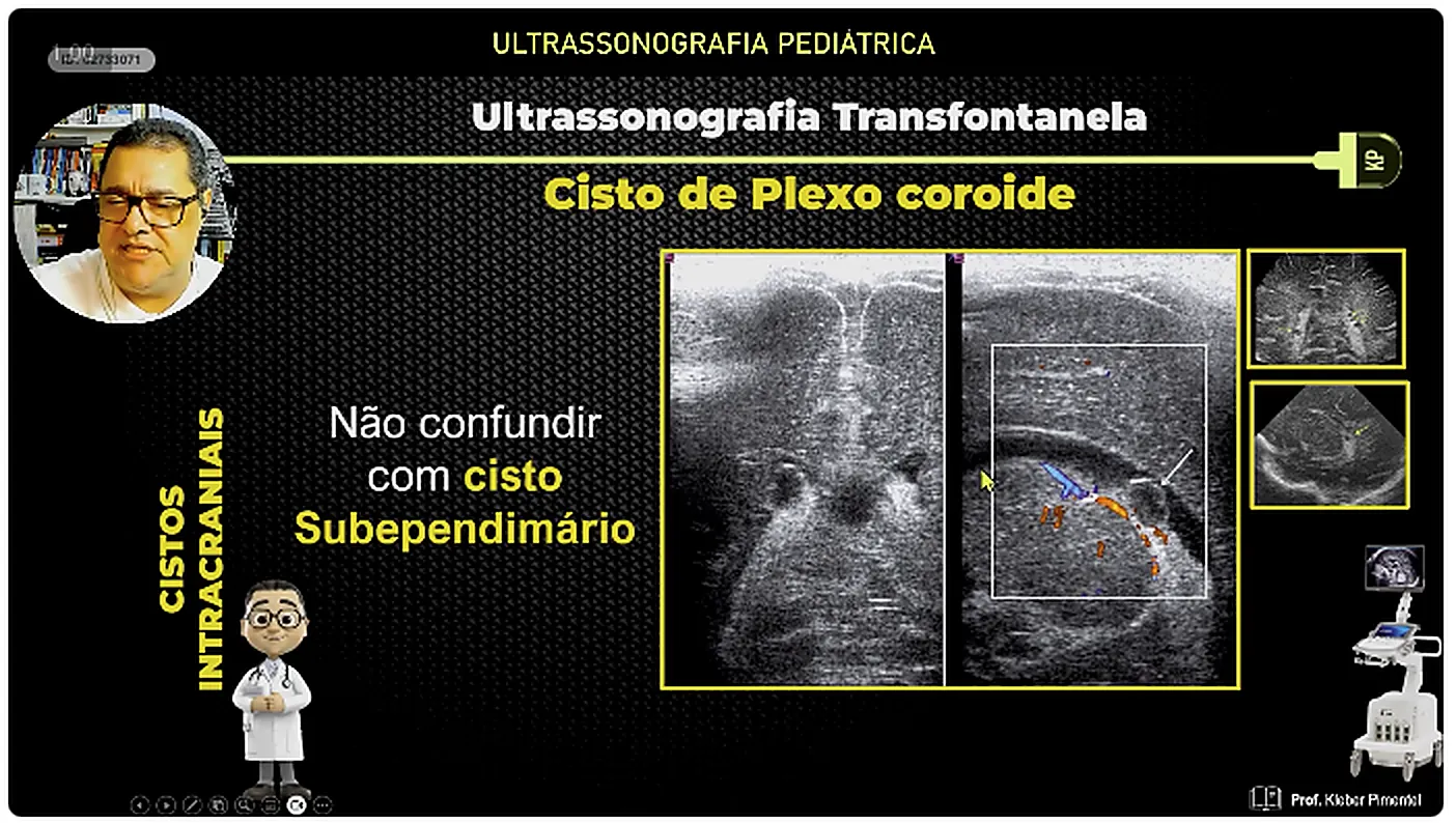 Slide da aula alertando para nao confundir cisto de plexo coroide com cisto subependimario